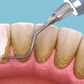 Effective Strategies to Prevent Plaque Buildup Between Teeth Cleanings