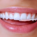 Teeth Cleaning and Its Impact on Daily Oral Hygiene
