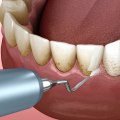 Understanding Teeth Cleaning with a History of Gum Disease
