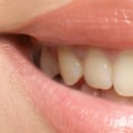 Understanding the Distinction Between Teeth Cleaning and Teeth Whitening