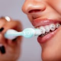 Teeth Cleaning with Braces: What You Need to Know