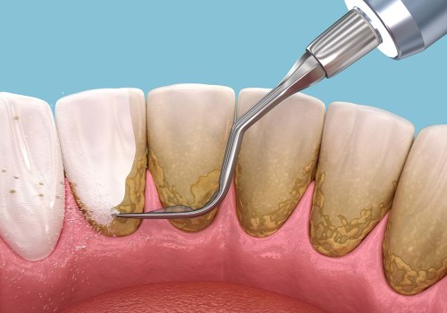Effective Strategies to Prevent Plaque Buildup Between Teeth Cleanings