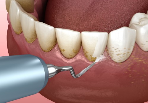 Understanding Teeth Cleaning with a History of Gum Disease