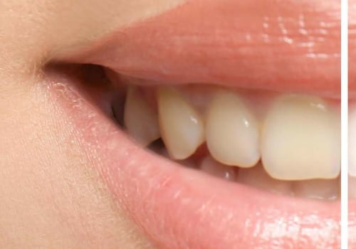 Understanding the Distinction Between Teeth Cleaning and Teeth Whitening