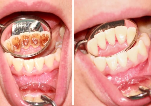 Understanding the Risks and Benefits of Teeth Cleaning