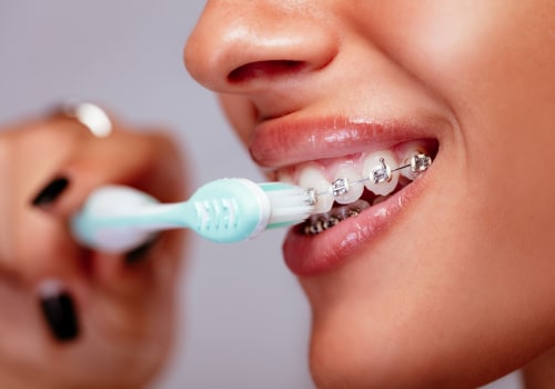 Teeth Cleaning with Braces: What You Need to Know